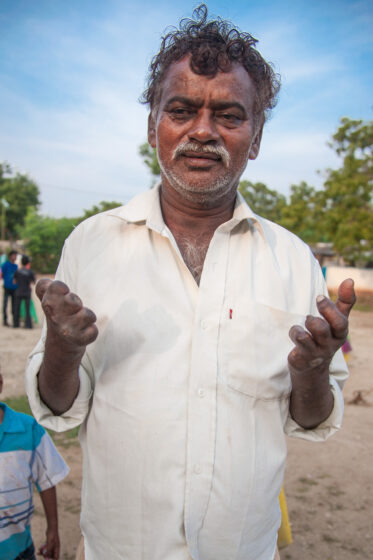 Nellore, Andhra Pradesh, India - 25 December 2014: Man with leprosy residing in a rehabilitation centre in rural India shows deformed hands.